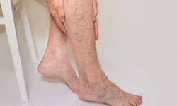 Các yếu tố nguy cơ gây suy tĩnh mạch chi dưới