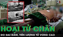 Lội xuống đầm tôm, người đàn ông hoại tử chân vì bị gai đâm, tiên lượng tử vong cao