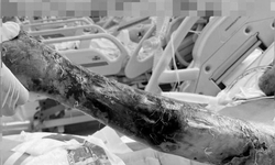 14 ng&#224;y căng thẳng gi&#224;nh giật sự sống cho bệnh nh&#226;n nhiễm vi khuẩn tụ cầu v&#224;ng