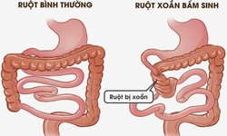 Đau bụng cảnh gi&#225;c với xoắn ruột cần nhập viện khẩn cấp