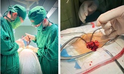 Bệnh viện Hữu nghị Đa khoa Nghệ An phẫu thuật th&#224;nh c&#244;ng u tủy h&#236;nh quả tạ