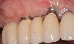 Implant bị đ&#224;o thải do đ&#226;u? C&#225;ch khắc phục?