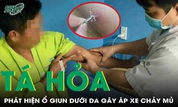 Kinh h&#227;i h&#236;nh ảnh giun rồng chui l&#234;n qua da, ph&#225;t hiện nhiều ổ giun &#225;p xe khắp cơ thể 