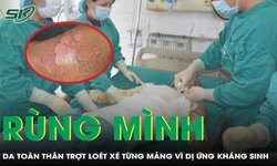 Rùng mình: Người phụ nữ bị lột da như phỏng nặng vì dị ứng kháng sinh 

