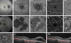 Cơ hội điều trị thành công căn bệnh gây mất thị lực ở trẻ em