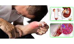 Bệnh gout ảnh hưởng thế n&#224;o đến tim, thận?