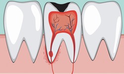Vi&#234;m tủy răng ở trẻ c&#243; biểu hiện g&#236;, hệ lụy ra sao?