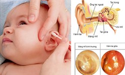 Trẻ dưới 2 tuổi bị vi&#234;m tai giữa cấp mủ: Cha mẹ cần l&#224;m g&#236; để cải thiện nhanh triệu chứng?