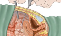 Nguy cơ mang thai ngoài tử cung, vô sinh từ căn bệnh phụ khoa ít triệu chứng