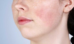 7 t&#225;c dụng phụ thường gặp khi sử dụng retinol v&#224; c&#225;ch ph&#242;ng ngừa