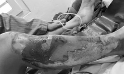 Nướng c&#225; bằng cồn người phụ nữ bị bỏng nặng