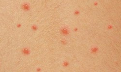 Cẩn trọng với bệnh thủy đậu g&#226;y biến chứng