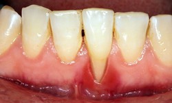 &#193;m ảnh tụt nướu: Dấu hiệu, nguy&#234;n nh&#226;n v&#224; &#39;l&#225; chắn&#39; bảo vệ nụ cười