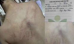 Cục B&#224; mẹ v&#224; Trẻ em l&#234;n tiếng về vụ trẻ bị bạo h&#224;nh ở H&#224; Nội