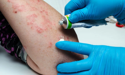 Thuốc điều trị bệnh vảy nến ở phụ nữ