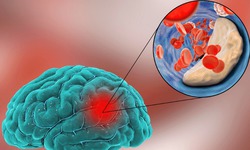 Nhồi m&#225;u n&#227;o cấp do đ&#226;u?