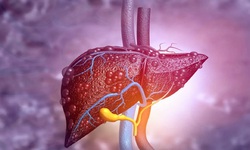 Xơ gan do rượu v&#224; c&#225;c dấu hiệu cảnh b&#225;o cần biết