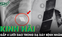 Kinh hãi nam thanh niên 26 tuổi nuốt trọn 4 lưỡi dao rọc giấy và 1 dao lam vào bụng
