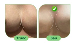 Điều trị ngực th&#244;ng khe sau n&#226;ng ngực