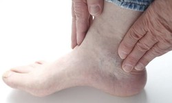 Biểu hiện biến chứng thận ở bệnh nh&#226;n tiểu đường