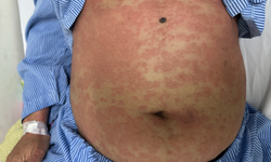 Một phụ nữ nguy kịch sau khi d&#249;ng thuốc giảm c&#226;n thải độc, collagen kh&#244;ng r&#245; nguồn gốc