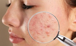 B&#244;i kem đ&#225;nh răng c&#243; gi&#250;p điều trị mụn trứng c&#225;?