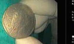 B&#233; trai 9 tuổi bất ngờ nuốt đồng xu khi đang ngậm trong miệng