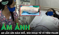 Tiêm filler toàn thân, cô gái trẻ ám ảnh suốt đời với 60 lần lên bàn mổ, đùi hoại tử lộ bó cơ