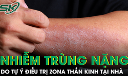 Tự chữa zona thần kinh, người đ&#224;n &#244;ng nhập viện v&#236; nhiễm tr&#249;ng nặng, vết thương chảy mủ