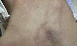 Bé gái mầm non nghi bị bạo hành, đánh tím lưng tại Hà Nội