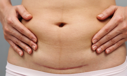 Những vấn đề cần lưu ý sau khi sinh mổ các bà mẹ cần biết