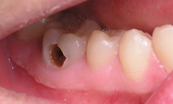 Nhận biết v&#224; đề ph&#242;ng s&#226;u răng ở trẻ
