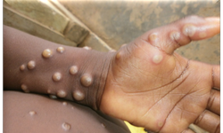 WHO khuyến cáo điều trị HIV sớm cho bệnh nhân đồng nhiễm Mpox