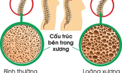 Lo&#227;ng xương: Ai cần đo mật độ xương v&#224; c&#225;ch ph&#242;ng ngừa hiệu quả?