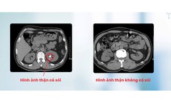 T&#225;n sỏi qua da cho người đ&#224;n &#244;ng bị dị tật thận đ&#244;i cực hiếm