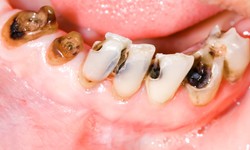 6 dấu hiệu thiếu canxi bạn kh&#244;ng n&#234;n bỏ qua
