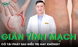 Gi&#227;n tĩnh mạch c&#243; t&#225;i ph&#225;t kh&#244;ng? Sự thật về căn bệnh nhiều người chủ quan