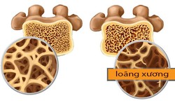 Lo&#227;ng xương: Dự ph&#242;ng v&#224; điều trị từ lối sống đến thuốc