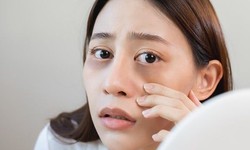 Quầng th&#226;m dưới mắt – Cảnh b&#225;o thiếu hụt chất dinh dưỡng n&#224;o?