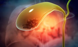 Vi&#234;m t&#250;i mật v&#224; c&#225;c phương ph&#225;p kiểm so&#225;t hiệu quả