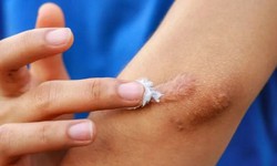 Bộ Y tế đ&#236;nh chỉ, thu hồi to&#224;n quốc, y&#234;u cầu ti&#234;u huỷ 1 loại gel &#39;ngừa sẹo&#39; do vi phạm 3 lỗi