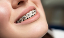 Vệ sinh răng nướu sau khi niềng răng: Bạn đ&#227; biết chưa?