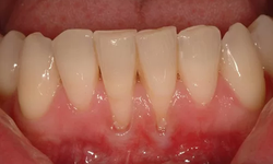 Tụt nướu ‘kh&#244;ng phanh’: Phục hồi nướu (lợi)  thẩm mỹ, lấy lại nụ cười rạng ngời