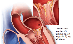Triệu chứng vi&#234;m nội t&#226;m mạc nhiễm tr&#249;ng