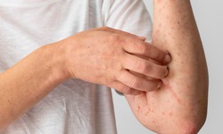 C&#225;c biện ph&#225;p ph&#242;ng ngừa vi&#234;m da cơ địa 
