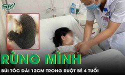 Phẫu thuật lấy búi tóc dài 12cm trong ruột bé gái 4 tuổi