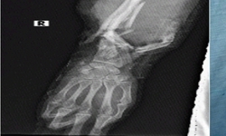 Thai phụ song thai 23 tuần được gh&#233;p b&#224;n tay v&#224;o cẳng ch&#226;n đ&#227; c&#243; thể đi lại