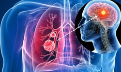 5 b&#237; quyết ph&#242;ng ngừa ung thư phổi cần biết