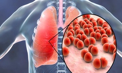 Ho ra m&#225;u cảnh gi&#225;c với bệnh nấm phổi