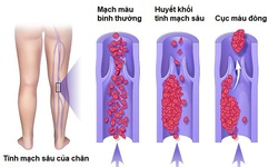C&#225;c yếu tố nguy cơ g&#226;y bệnh huyết khối tĩnh mạch s&#226;u